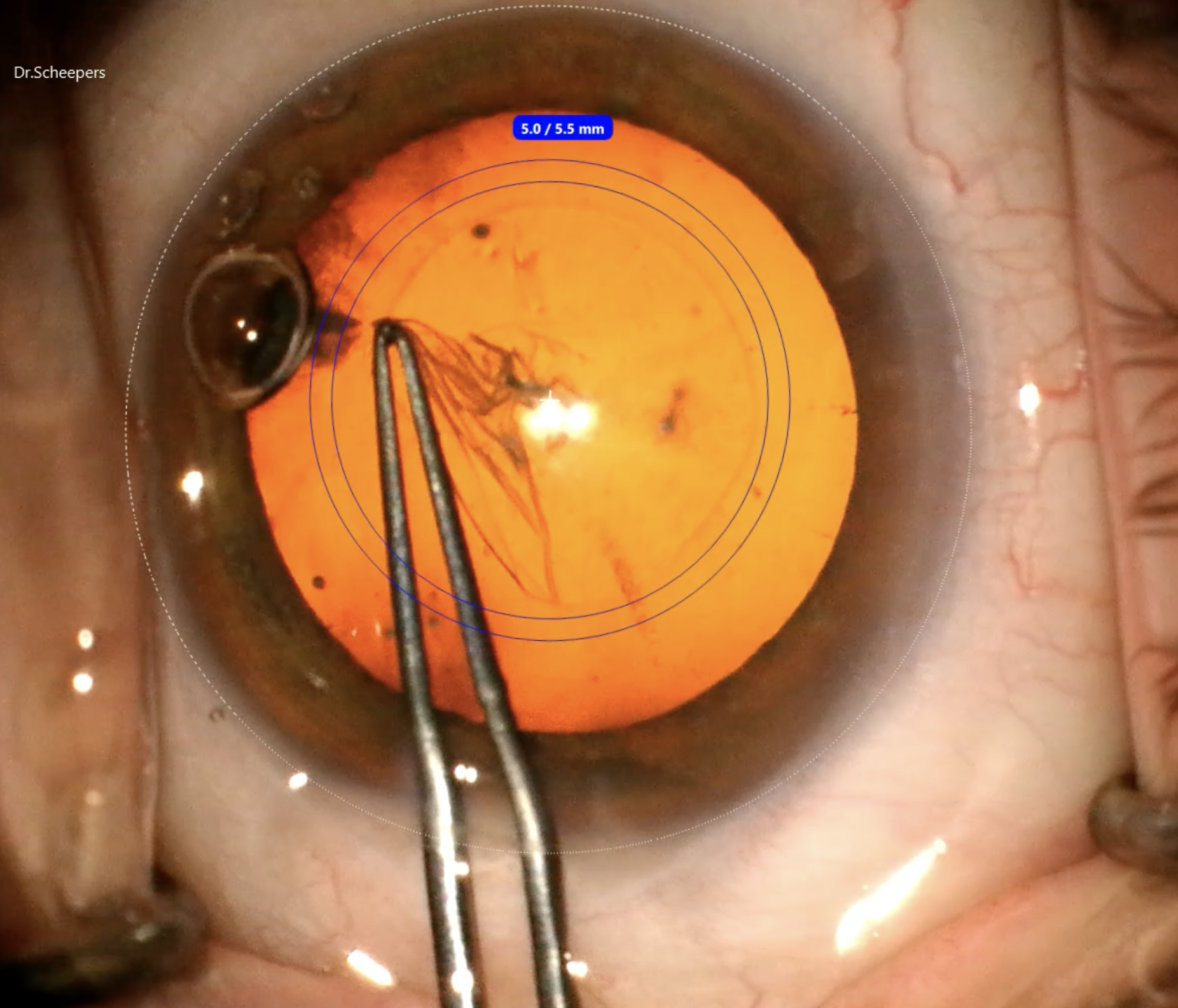 Callisto Eye circular overlay guiding capsulorrhexis — 5.0/5.5 mm centred on visual axis