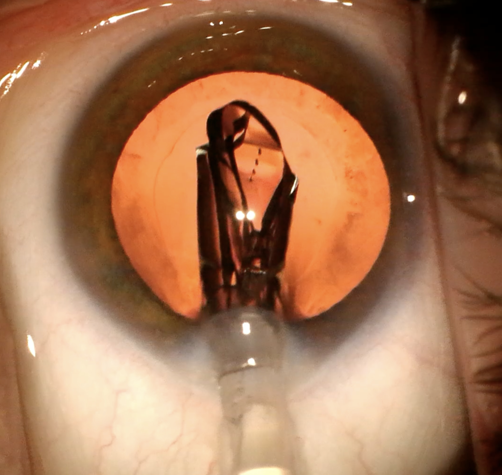 Touchless intraocular lens insertion through a preloaded injector cartridge