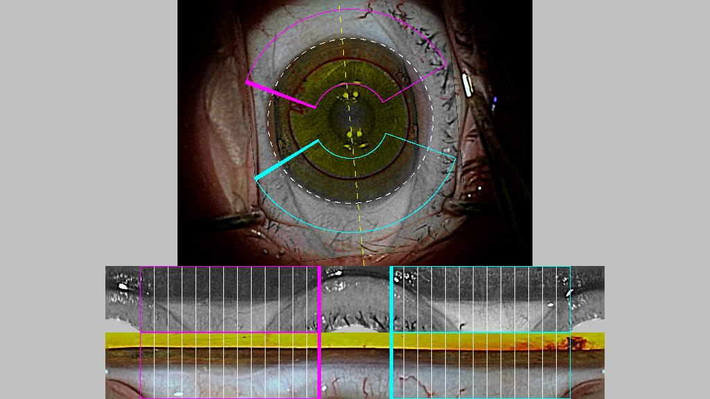 ZEISS Callisto Eye reference image — coloured overlays map the eye's landmarks