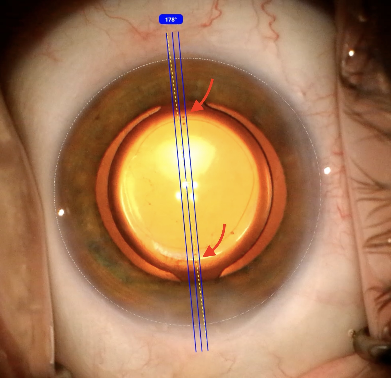 Callisto digital overlay at 178° aligning toric lens — red arrows indicate lens alignment marks