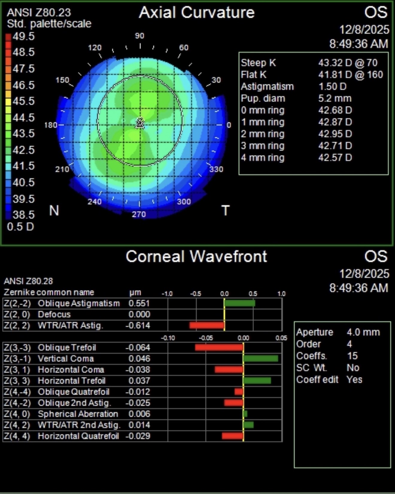 Pre-operative corneal topography — 1.50 D astigmatism, bow-tie pattern visible